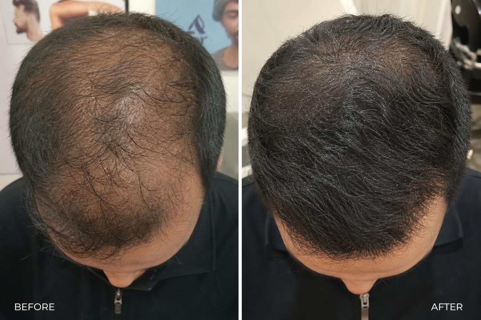 Before and after — Premium Hair Transplant